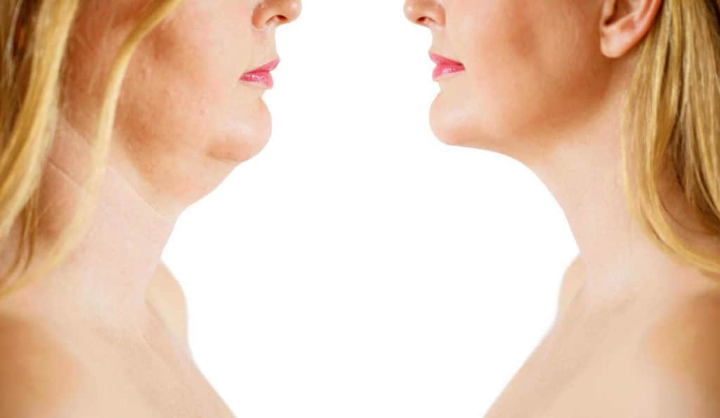 Double Chin treatment Chalk Farm before and after results