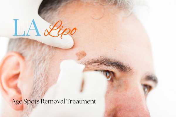 What Are the Most Effective Treatments for Age Spots Chalk Farm?