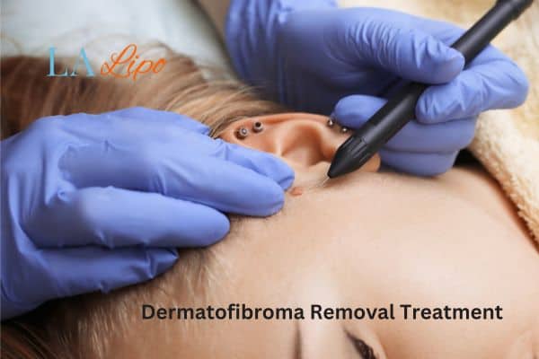 Dermatofibroma Removal Treatment Chalk Farm