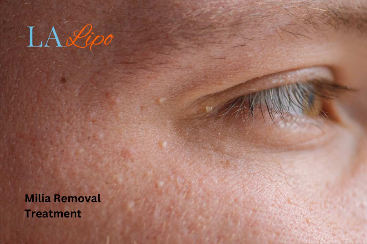 Cryopen Milia Removal: Is It the Easiest and Safest Option Chalk Farm?