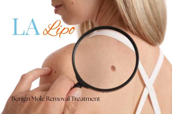 Why getting moles removed Chalk Farm can boost your confidence!