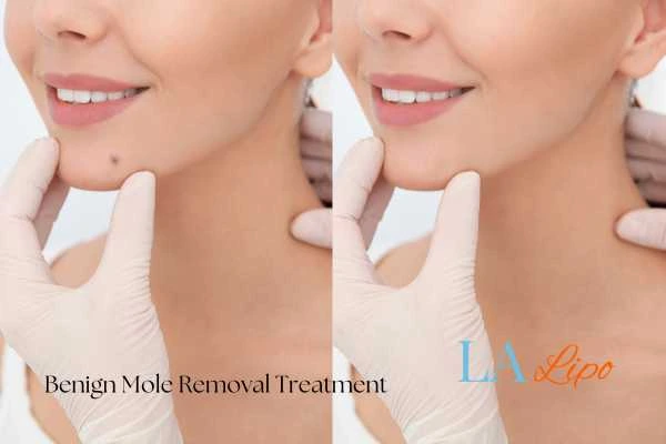 Woman's before and after results of being moles removal treatment Chalk Farm