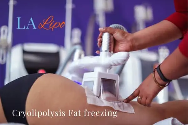 women getting fat freezing Chalk Farm