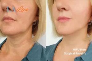 hi-fu for wrinkles Chalk Farm before and after results