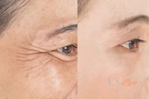 Before and after results of woman - HI-fu wrinkles reduction treatment Chalk Farm