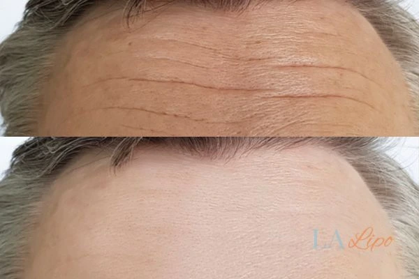 results of HIFU Chalk Farm on mans forehead to help reduce lines and wrinkles