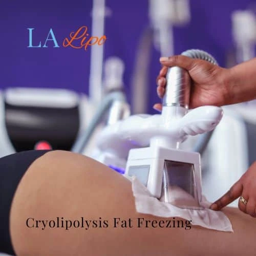 fat freezing - Cryolipolysis Chalk Farm