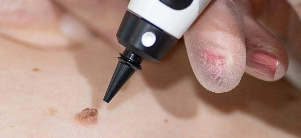 skin tag removal using cryopen Chalk Farm