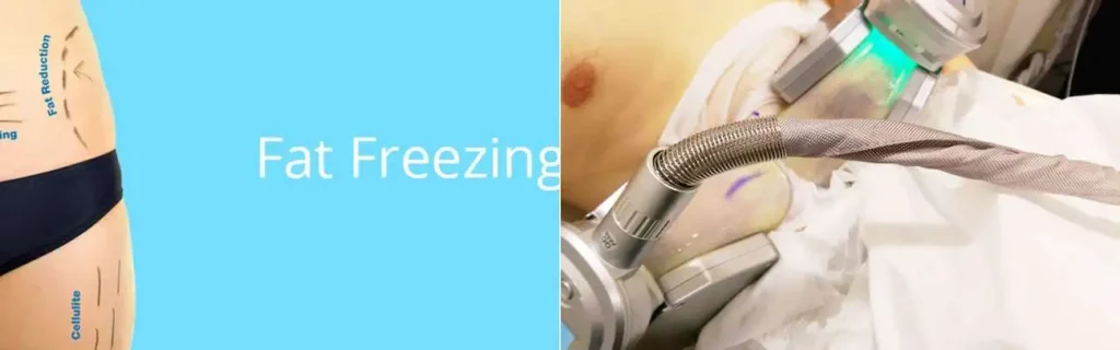 Fat freezing Chalk Farm on multiple areas of the body