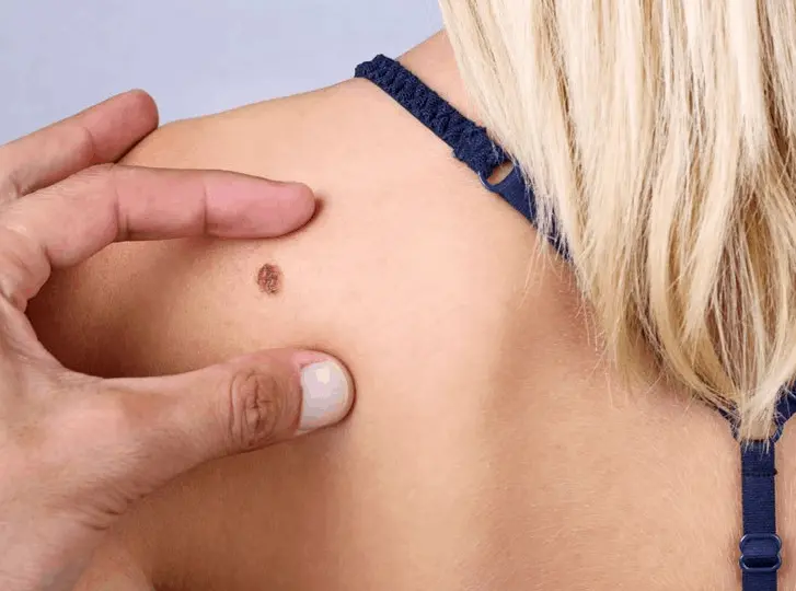 woman having mole removal Chalk Farm consultation before treatment.