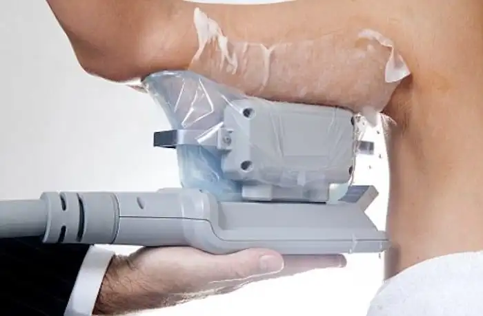 Picture of fat freezing Chalk Farm on the upper arms.