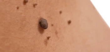 image of a skin tag Chalk Farm