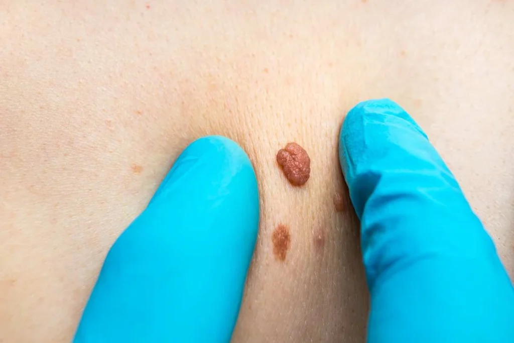 Consultant examining a skin tag Chalk Farm