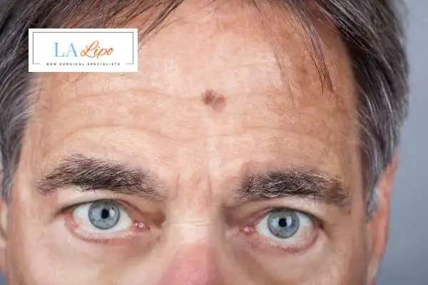 Solar Lentigo Removal Chalk Farm image of man with mark on his forehead