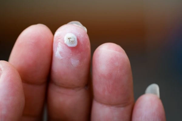 wart on person finger - cryotherapy to treat from LA LIPO Chalk Farm