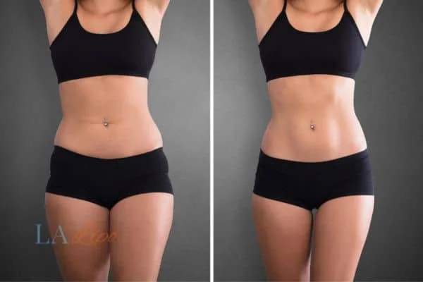 before and after results of non-surgical treatment to help a woman's body image and mental health Chalk Farm