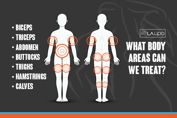Diagram to show areas you can have LA-EMS Body Sculpting Treatment Chalk Farm
