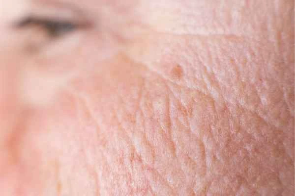 close up picture of a woman's face showing an age spot Chalk Farm