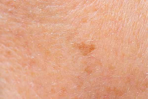 close up picture of age spots Chalk Farm