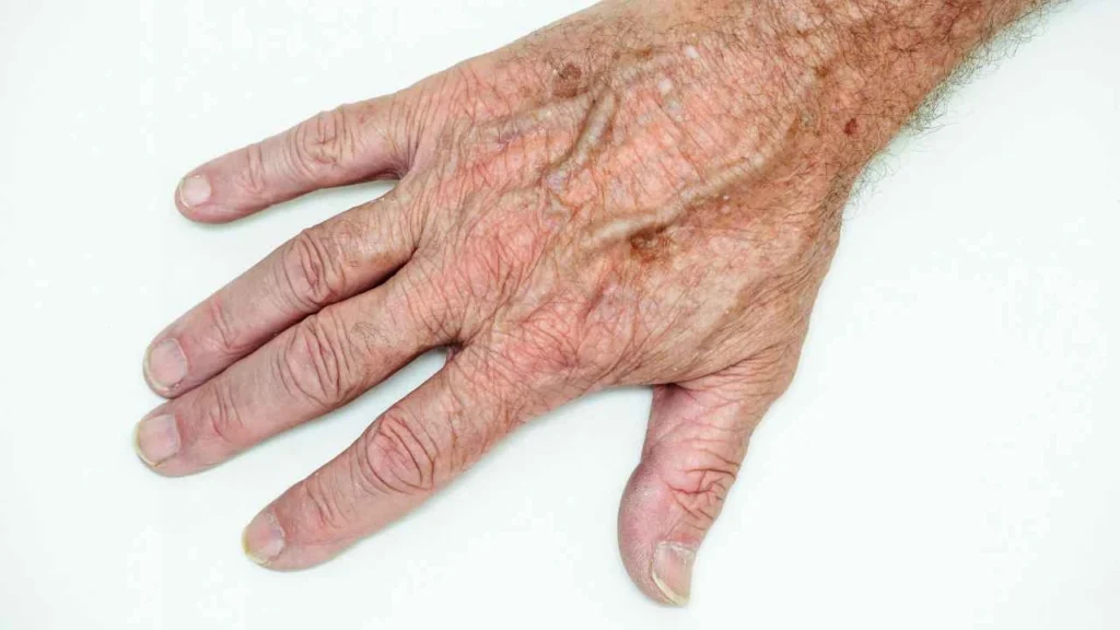 Male hand showing age spot Chalk Farm