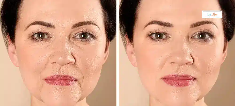 How Long Does It Take to See Results and How Long Do They Last Chalk Farm?